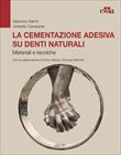 La cementazione adesiva su denti naturali