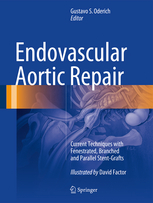 Endovascular Aortic Repair