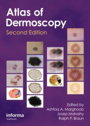 An Atlas of Dermoscopy, Second Edition