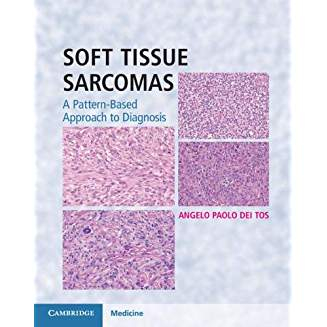 Soft Tissue Sarcomas