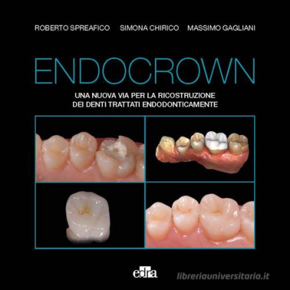 Endocrown