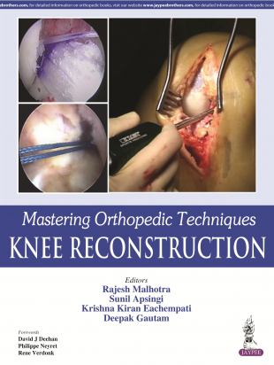 Mastering Orthopedic Techniques: Knee Reconstruction