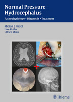 NPH - Normal Pressure Hydrocephalus 