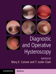 Diagnostic and Operative Hysteroscopy