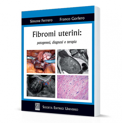 Fibromi uterini: patogenesi, diagnosi e terapia