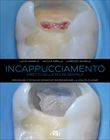 Incappucciamento Diretto della Polpa Dentale