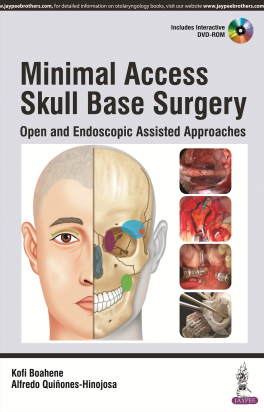 Minimal Access Skull Base Surgery