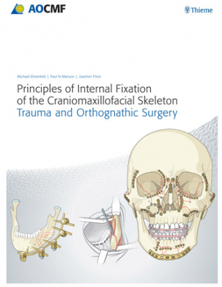 Principles of Internal Fixation of the Craniomaxillofacial Skeleton