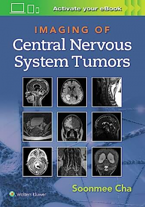 Imaging of Central Nervous System Tumors