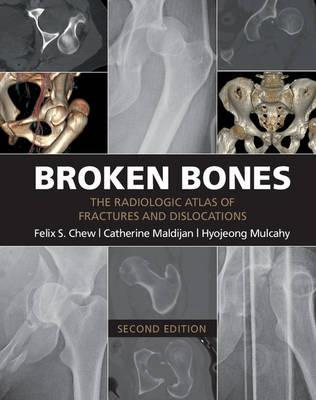 Broken Bones, 2nd Edition