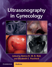 Ultrasonography in Gynecology