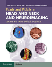 Pearls and Pitfalls in Head and Neck  Neuroimaging -.Variants and Other Difficult Diagnoses