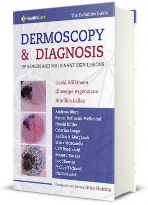 Dermoscopy and Diagnosis of Benign and Malignant Skin Lesions