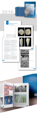 Laser in Endodonzia