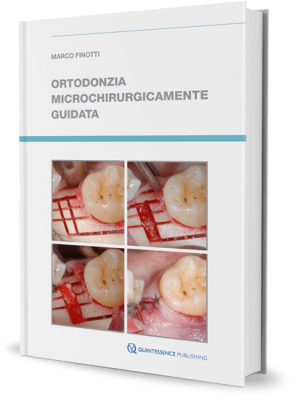 Ortodonzia Microchirugicamente Guidata