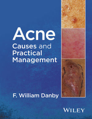 Acne: Causes and Practical Management