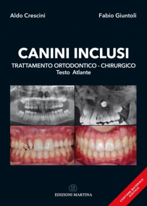 CANINI INCLUSI Trattamento Ortodontico-Chirurgico