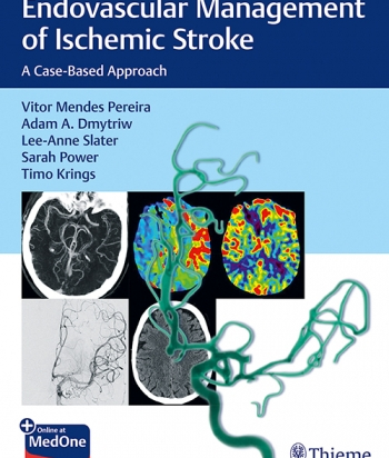 Endovascular Management of Ischemic Stroke