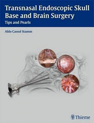 Transnasal Endoscopic Skull Base and Brain Surgery