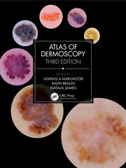 Atlas of Dermoscopy Third Edition