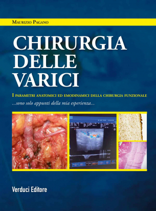 Chirurgia delle Varici