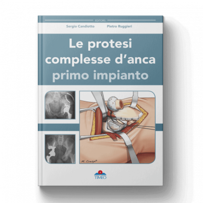 Le protesi complesse d’anca – primo impianto