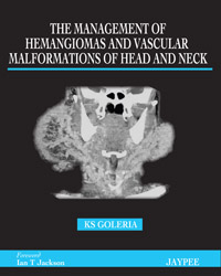 The Management of Haemangiomas and Vascular Malformations of Head and Neck  