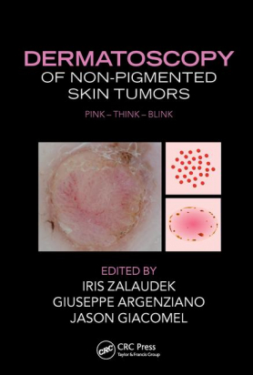 Dermatoscopy of Non-Pigmented Skin Tumors: Pink - Think - Blink
