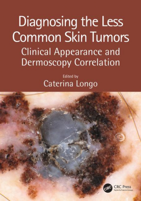 Diagnosing the Less Common Skin Tumors