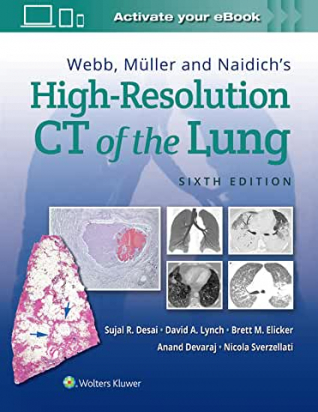 Webb, Müller and Naidich's High-Resolution CT of the Lung - Sixth edition