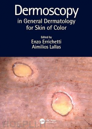 Dermoscopy in General Dermatology for Skin of Color