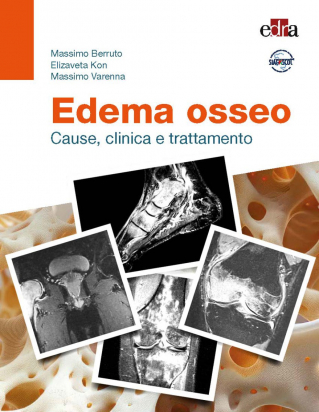 Edema Osseo