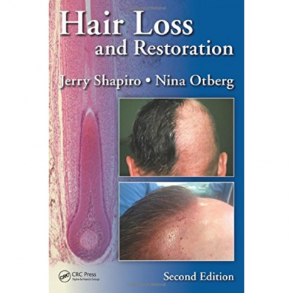 Hair Loss and Restoration, Second Edition