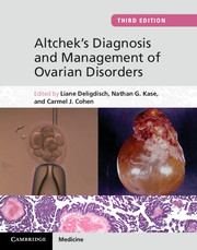 Altchek's Diagnosis and Management of Ovarian Disorders