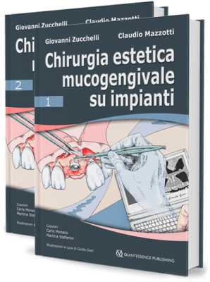 Chirurgia Estetica Mucogengivale su Impianti
