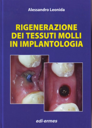 Rigenerazione dei tessuti molli in implantologia 