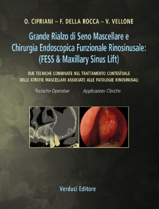 Grande Rialzo di Seno Mascellare e Chirurgia Endoscopica Funzionale Rinosinusale: (FESS &amp; Maxillary Sinus Lift)