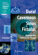 Dural Cavernous Sinus Fistulas (Softcover)