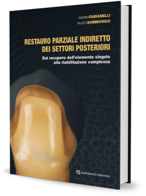 Restauro Parziale Indiretto dei Settori Posteriori